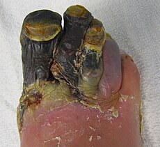 230px-GangreneFoot.JPG