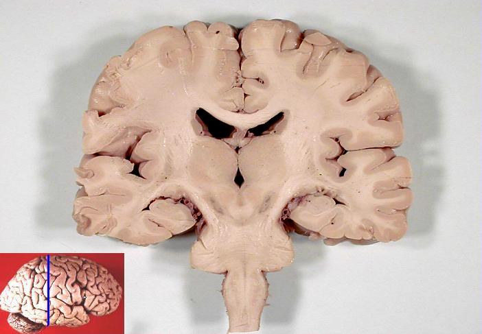 Human_brain_frontal_%28coronal%29_section.JPG